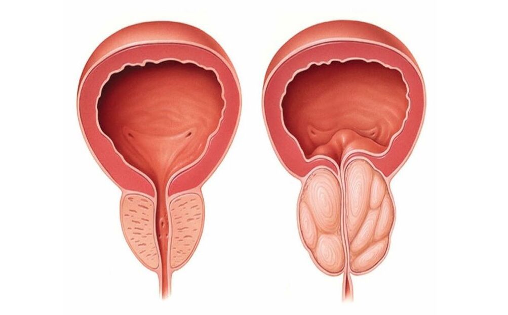 normalna i zapalna prostata