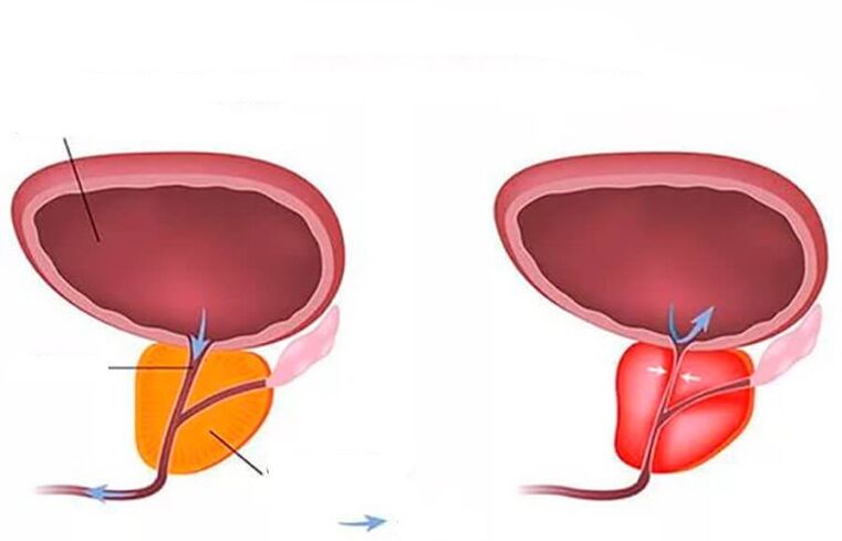 normalna i zapalna prostata