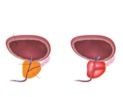 Normalna i zapalna prostata